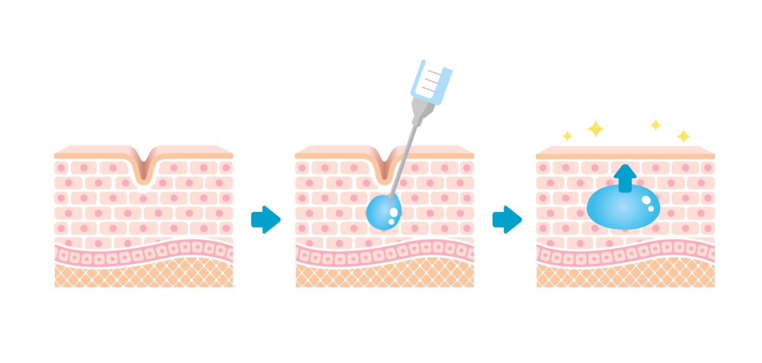 なぜ、ヒアルロン酸注入が効くのか？