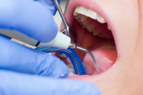 歯石除去をやるとどうなる？歯茎・口臭・噛み心地など口の中で起きる変化