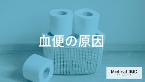 血便の原因:どこから出血しているのか