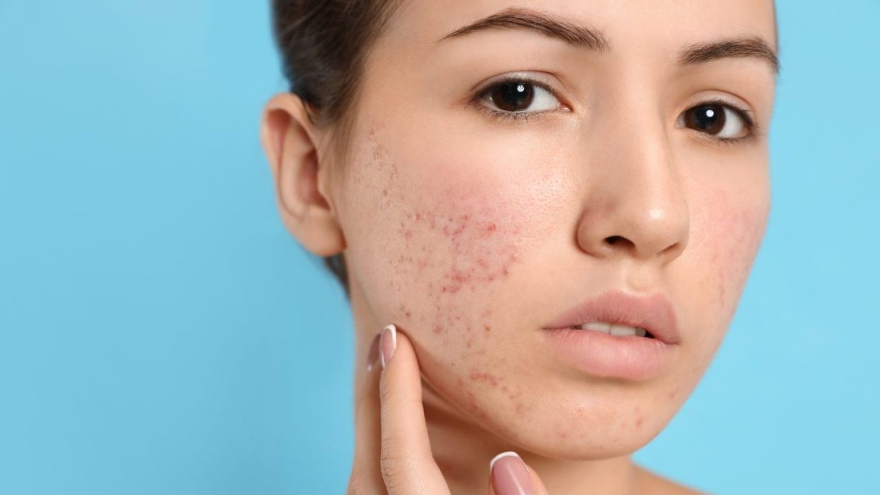 ニキビの重症化を防ぐには? 早めに治療へ行くべき理由を医師が解説