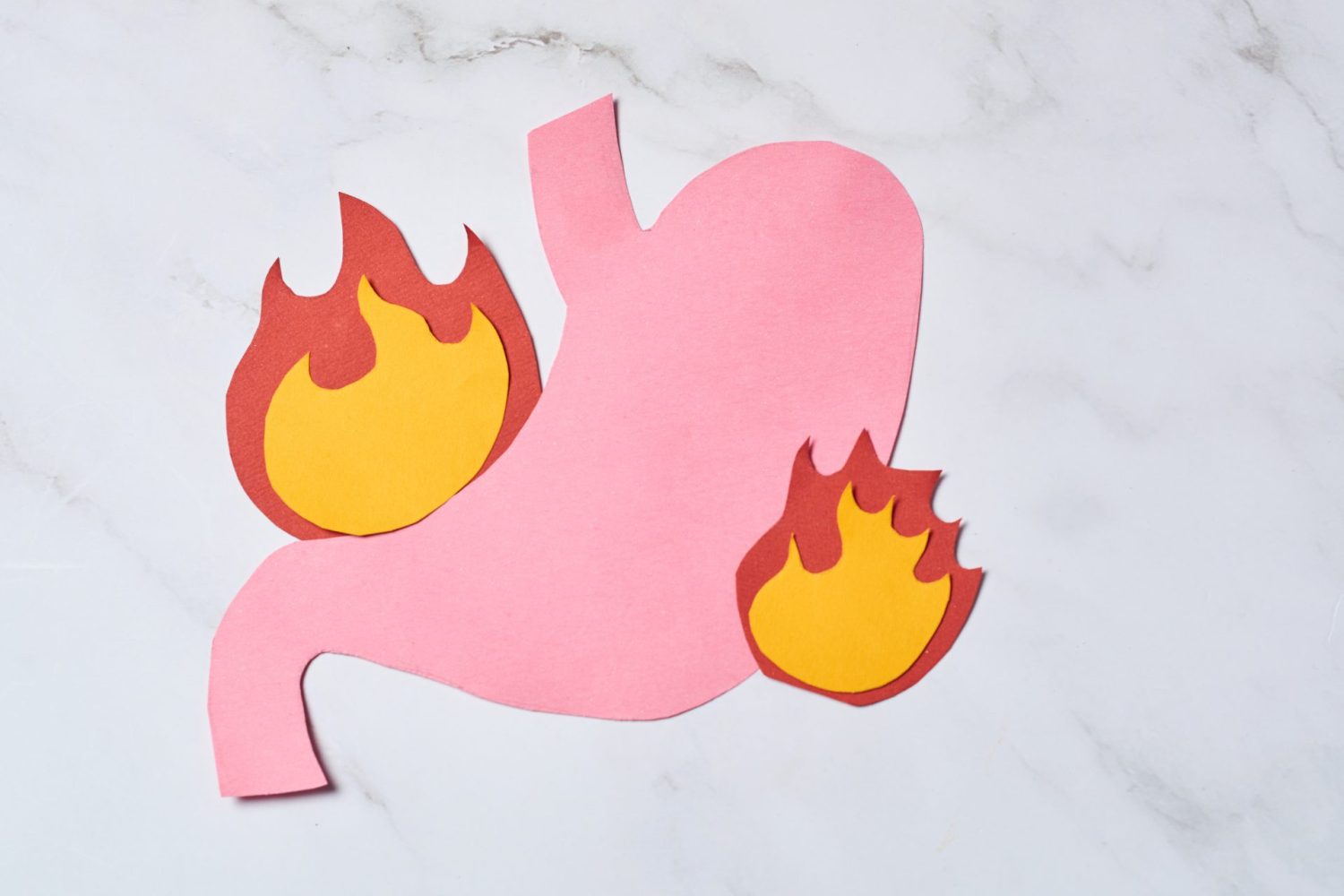 胃潰瘍のステージとは