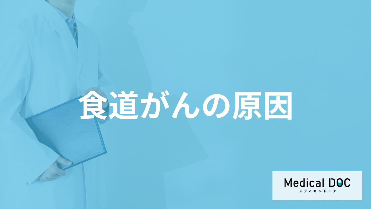 「食道がんの原因」はご存知ですか？発症しやすい人の特徴も医師が解説！