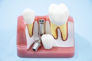 インプラントは破損することもある？破損の原因や対応方法を解説