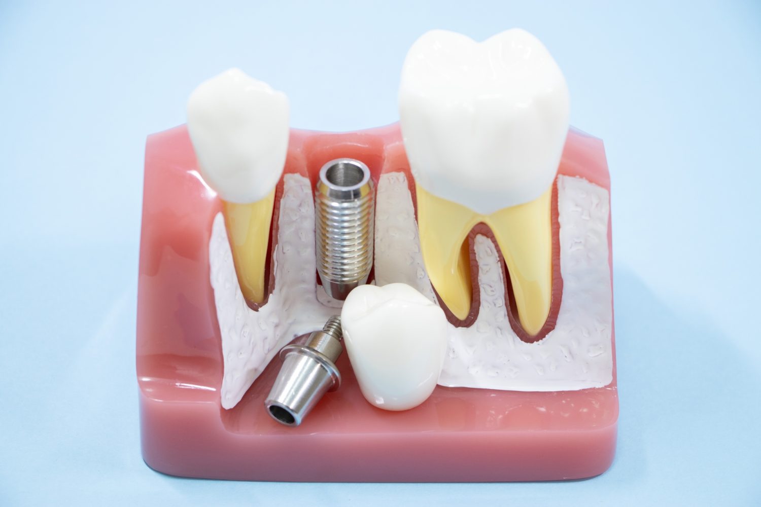 インプラントは破損することもある?破損の原因や対応方法を解説