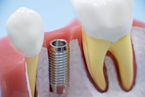 インプラントの修理は可能？修理が必要なケースや再治療について解説
