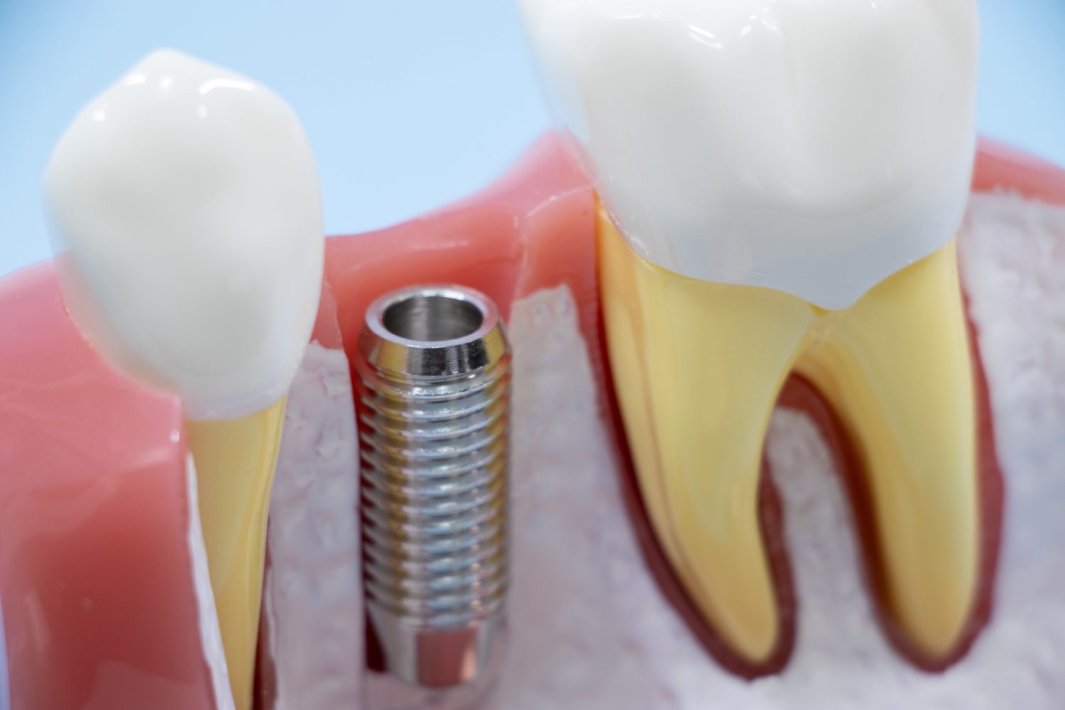 インプラントの修理は可能？修理が必要なケースや再治療について解説