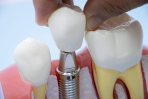 インプラントを抜くときの治療法や除去のリスクなどについて解説