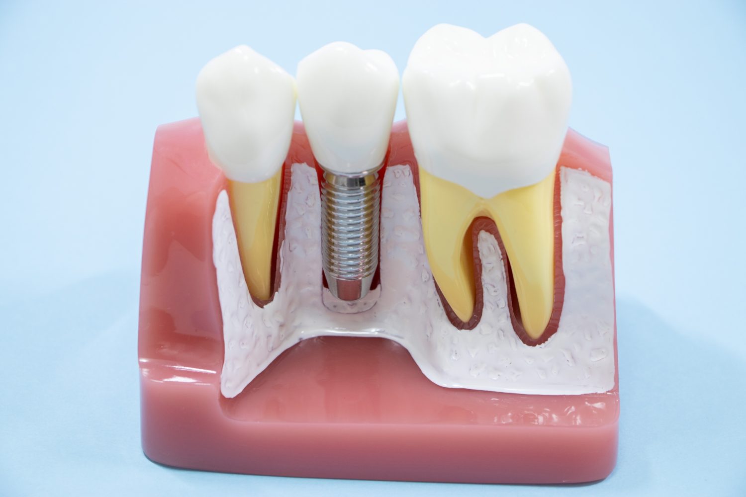 インプラント治療直後の歯茎腫れの原因と経過