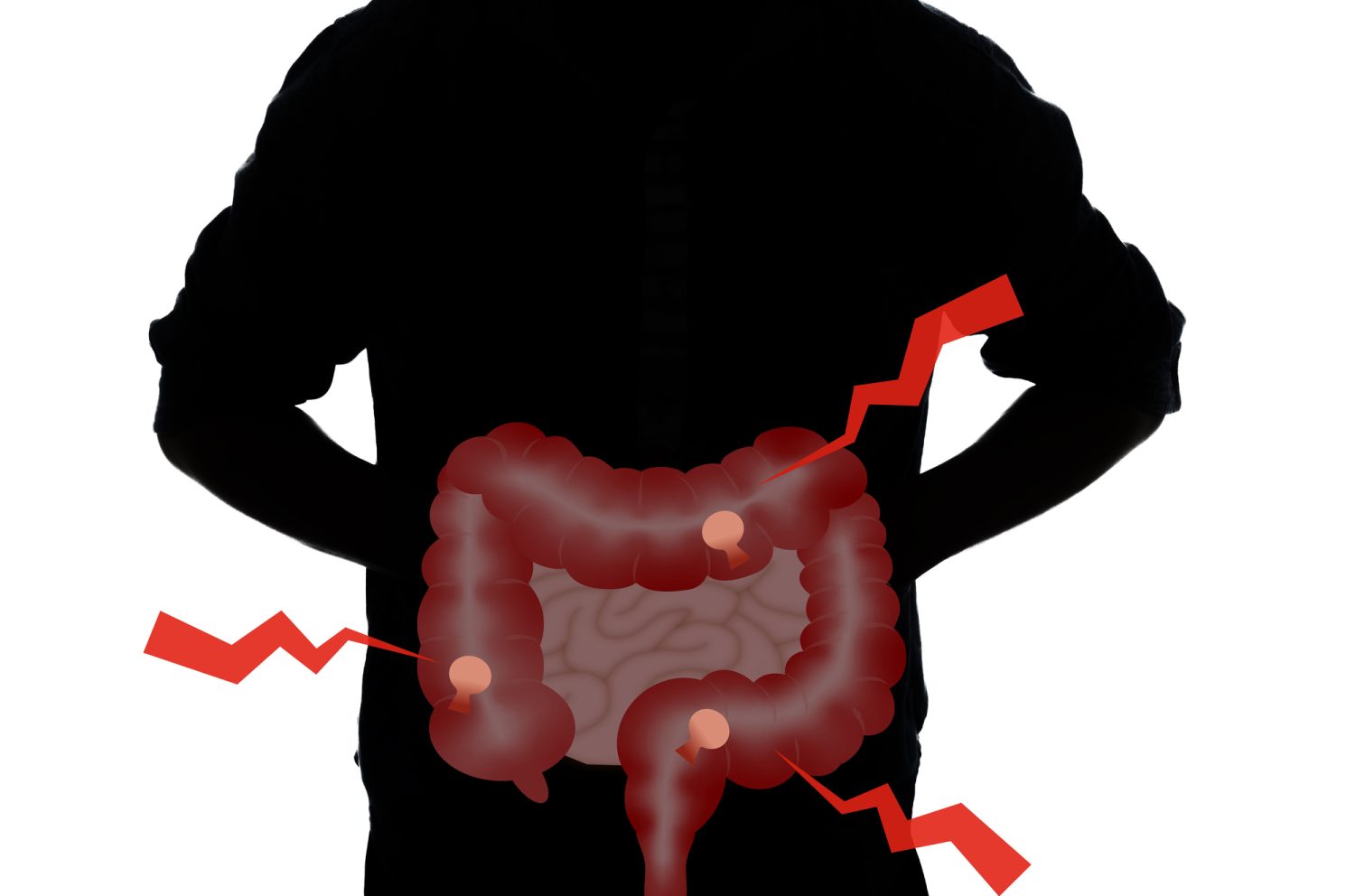 大腸ポリープができやすい人の特徴とは? 無症状でも安心できない40代からの大腸カメラ(大腸内視鏡)のススメ