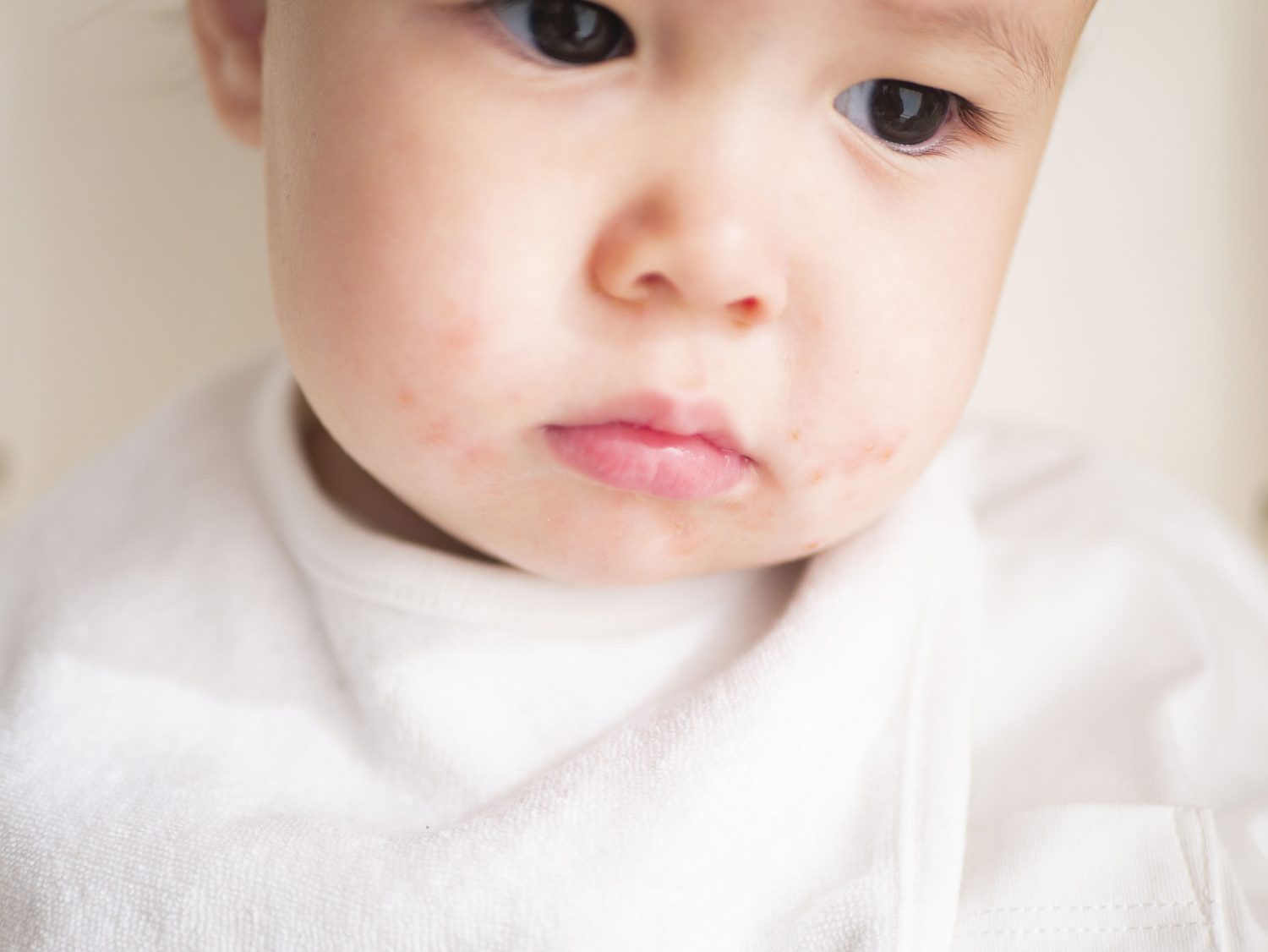 予防接種をしてもかかってしまった！