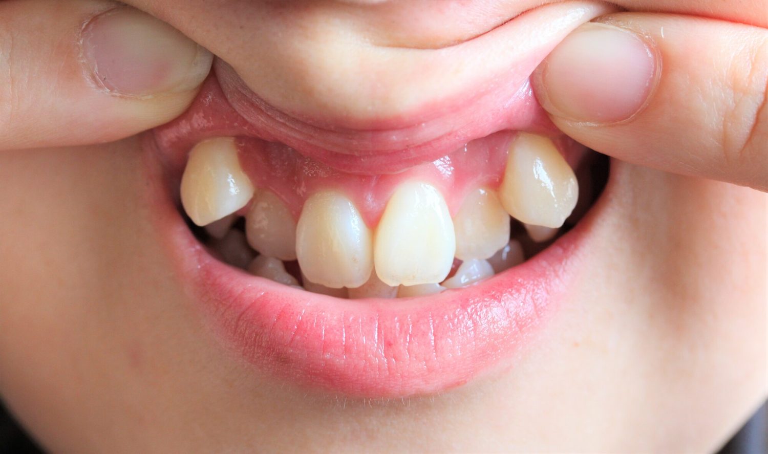 そもそも「予防矯正」ってどんな治療？ 目的と始めるタイミング