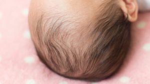 赤ちゃんの『頭のゆがみ』は自然に治る？ 受診目安と「ヘルメット治療」【医師解説】