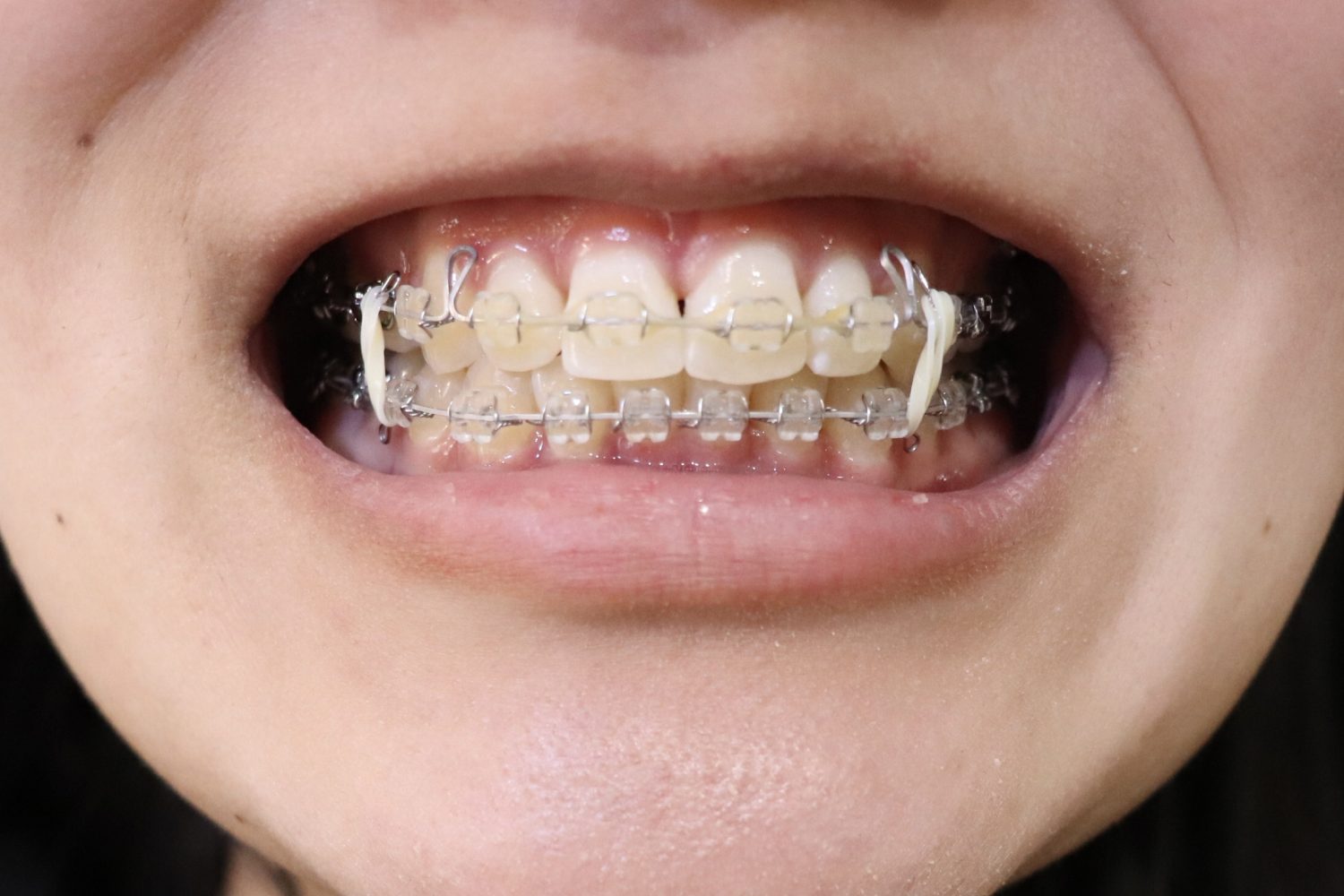 知っておくと安心! ワイヤー矯正治療中の自己管理