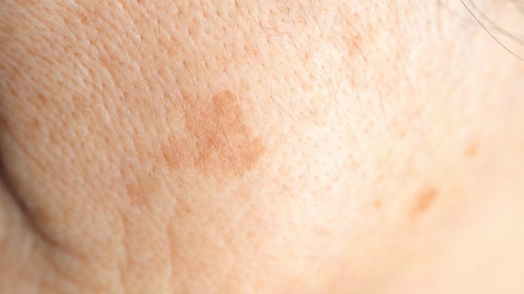 皮膚科医が教える「セルフケアが有効なシミ」とそうじゃないシミの違いの見分け方