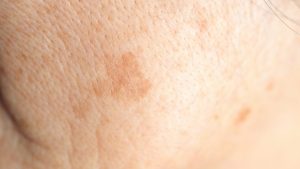 皮膚科医が教える「セルフケアが有効なシミ」とそうじゃないシミの違いの見分け方