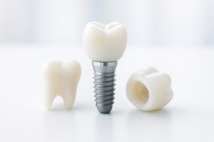 歯がボロボロの原因と解決法｜インプラントを含めた再建治療の全体像