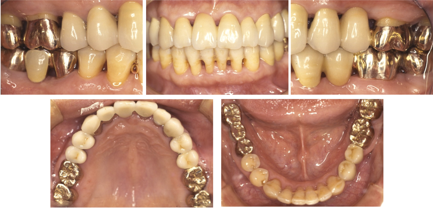 治療終了時外科処置を伴う歯周病治療、歯周補綴治療の症例紹介（コーヘイデンタルオフィス）