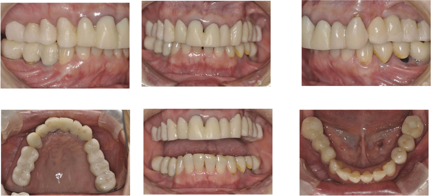 治療中インプラント5本を含む包括歯科治療の症例紹介（コーヘイデンタルオフィス）