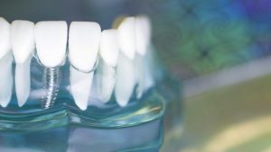 『インプラント手術』後の「痛み」「腫れ」への対処法！ 食事や歯磨きの注意点を徹底解説