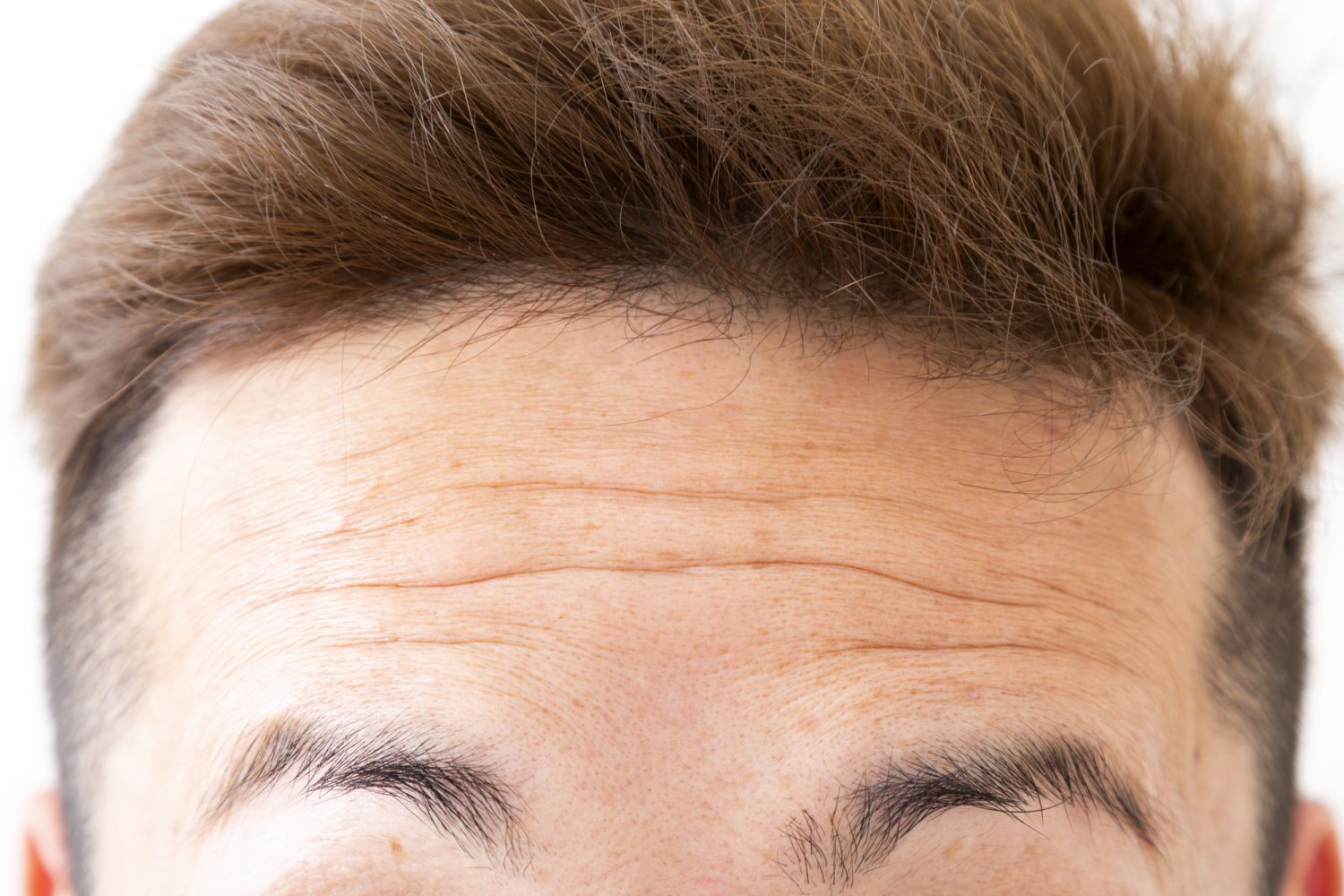 眼瞼下垂の手術で、おでこのしわが改善できる？