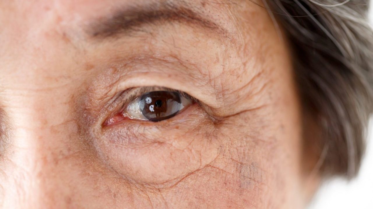 『白内障』の治療は早めが安心！ 手術の適切なタイミングと放置するリスクを紹介