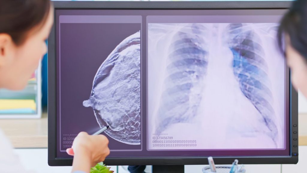 乳腺濃度（デンスブレスト）と検診のすれ違い…見逃しリスクをどう補完するか