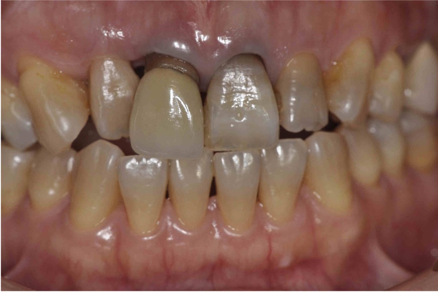 ビフォー前歯4本の再根管治療と審美修復治療の症例紹介（コーヘイデンタルオフィス）