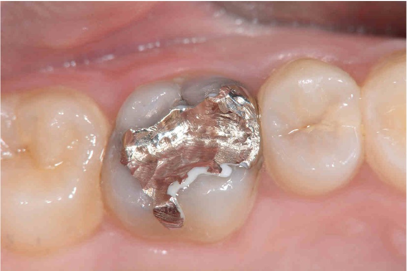 ビフォーセラミックインレーの症例紹介（コーヘイデンタルオフィス）