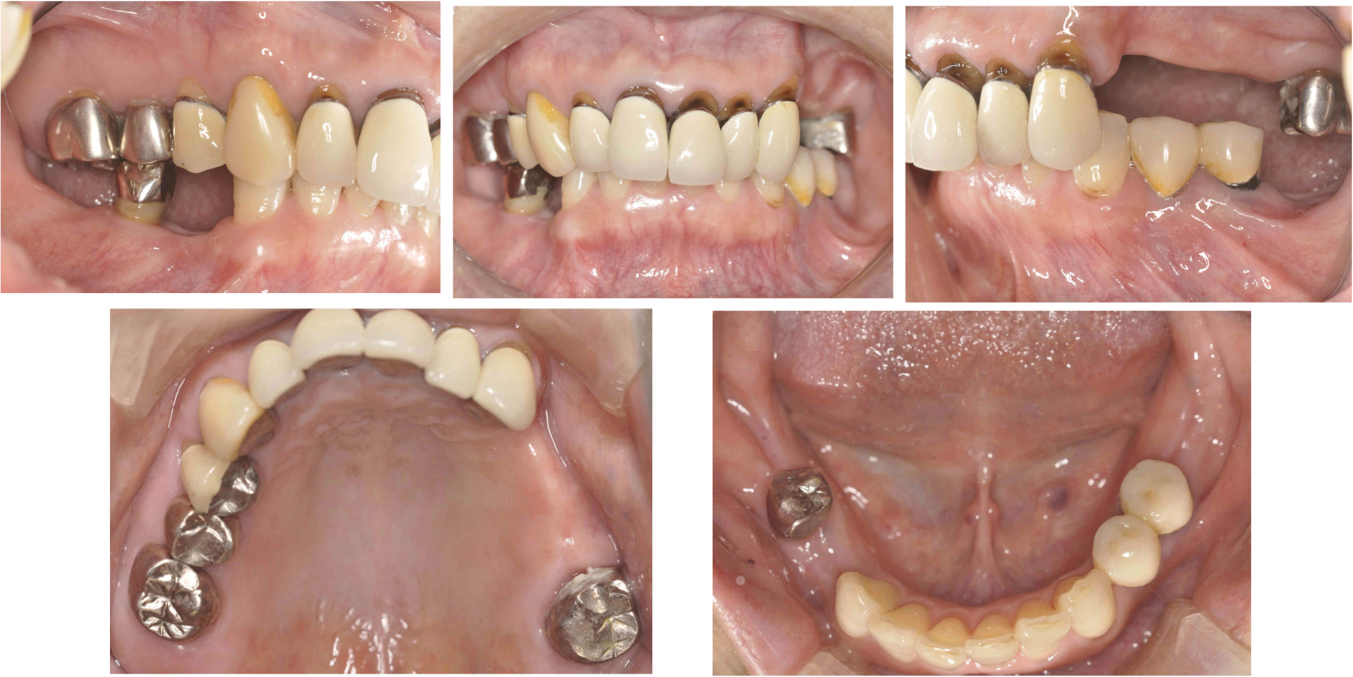ビフォーインプラント5本を含む包括歯科治療の症例紹介（コーヘイデンタルオフィス）