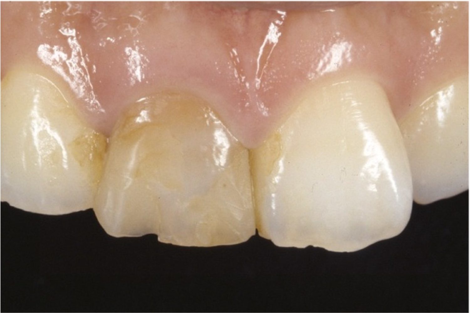 ビフォー前歯1本の審美修復の症例紹介（コーヘイデンタルオフィス）