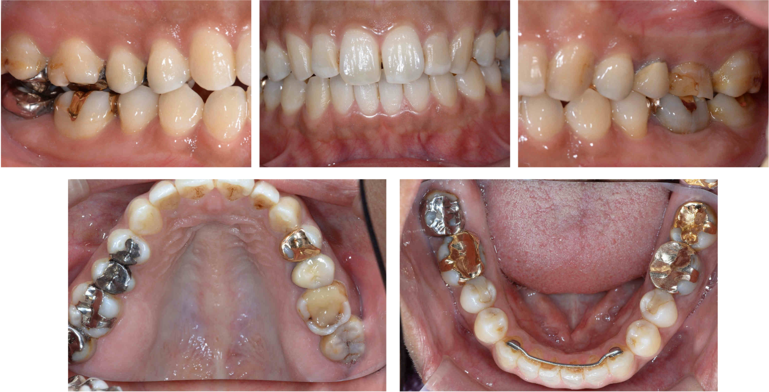ビフォーホワイトニング、噛み合わせの調整、奥歯14本前歯2本のセラミック治療の症例紹介（コーヘイデンタルオフィス）