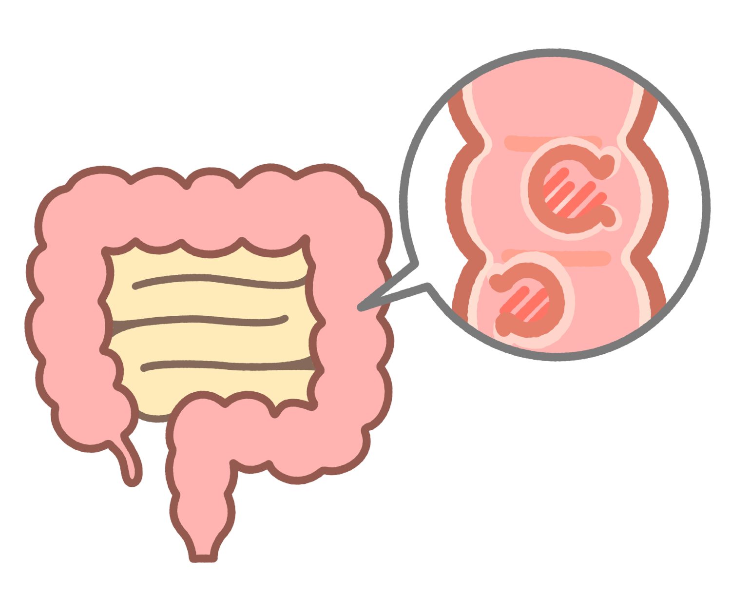 なぜ、陰性でも大腸がんが見つかることがあるのか?