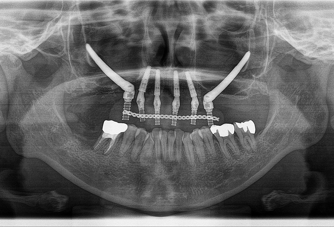 ザイゴマインプラントは本当にリスクを伴う治療なのか？