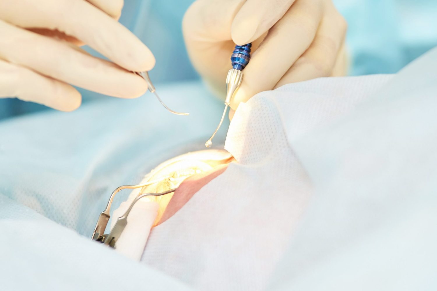 白内障の手術後に目がぼやける理由