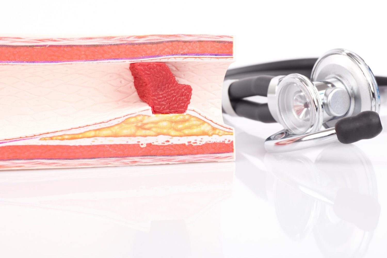 動脈硬化と糖尿病の関係