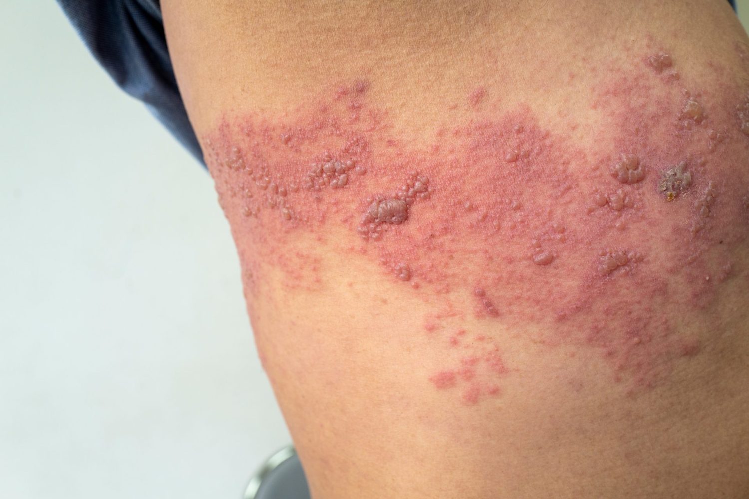 帯状疱疹|かゆみが生じる段階と特徴