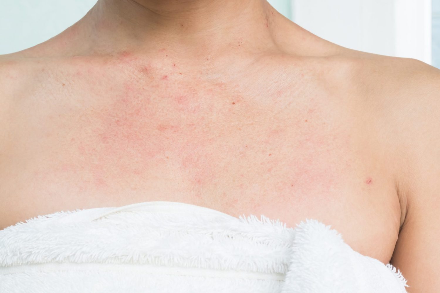 温熱蕁麻疹の基礎知識