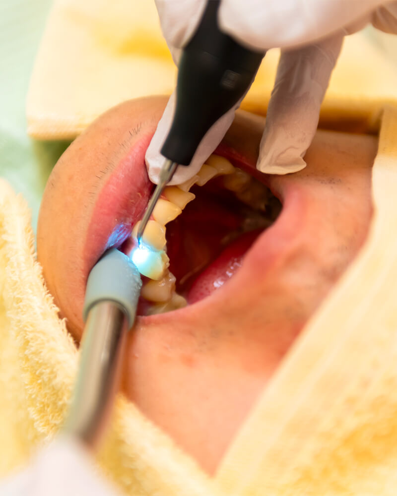 ブルーラジカルは原因菌を99.99％殺菌。重度歯周病の回復を助ける