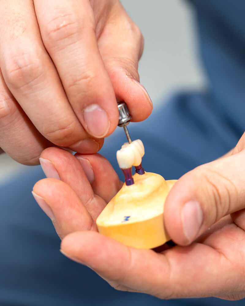 片顎全体の人工歯を4本のインプラントで支える「オールオン4」