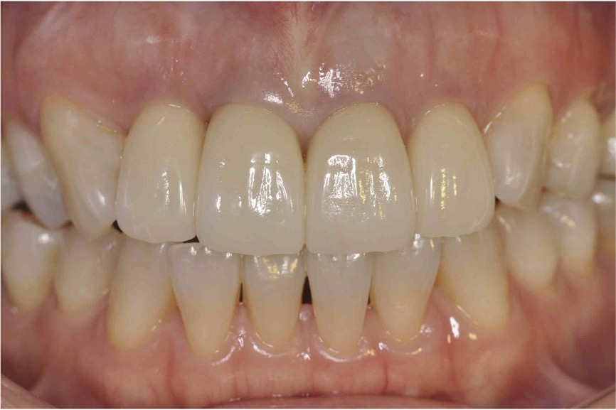 アフター前歯4本の再根管治療と審美修復治療の症例紹介（コーヘイデンタルオフィス）