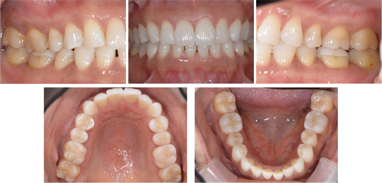 アフターホワイトニング、前歯2本のラミネートべニア治療、奥歯10本のセラミック治療の症例紹介（コーヘイデンタルオフィス）