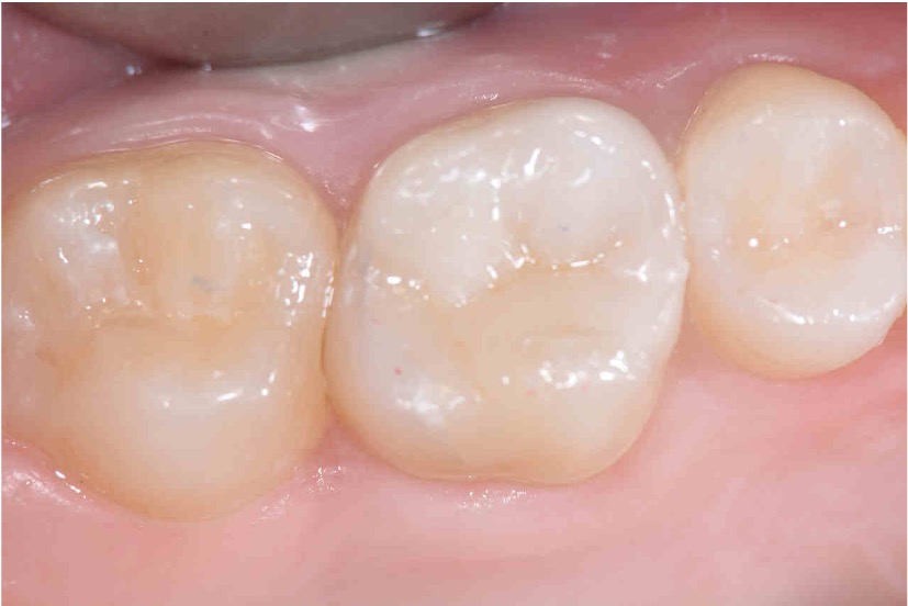 アフターセラミックインレーの症例紹介（コーヘイデンタルオフィス）