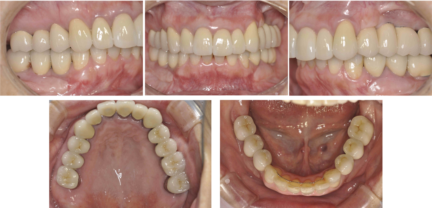 アフターインプラント5本を含む包括歯科治療の症例紹介（コーヘイデンタルオフィス）
