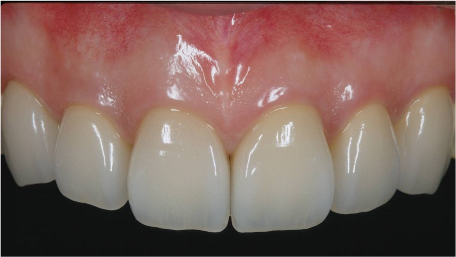 アフター前歯６本の審美修復治療の症例紹介（コーヘイデンタルオフィス）