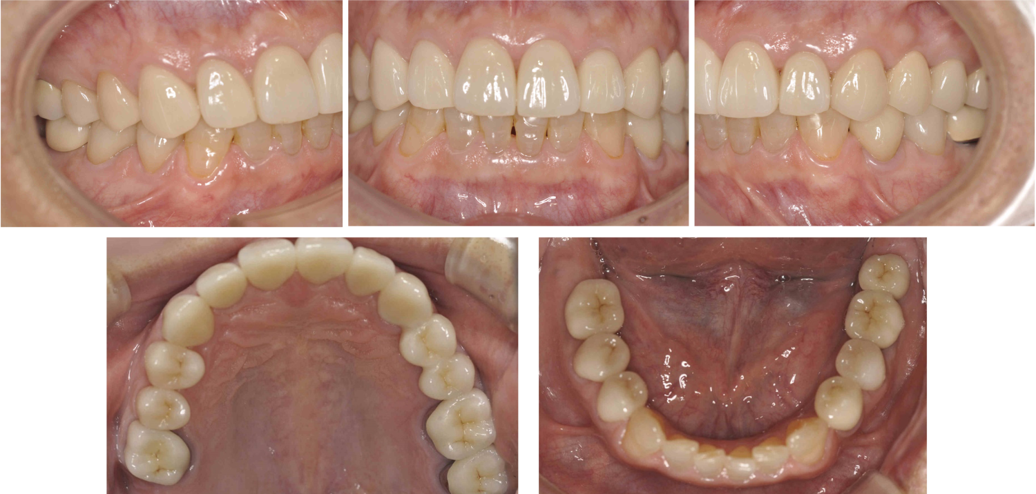 アフターインプラント3本を含む包括歯科治療の症例紹介（コーヘイデンタルオフィス）