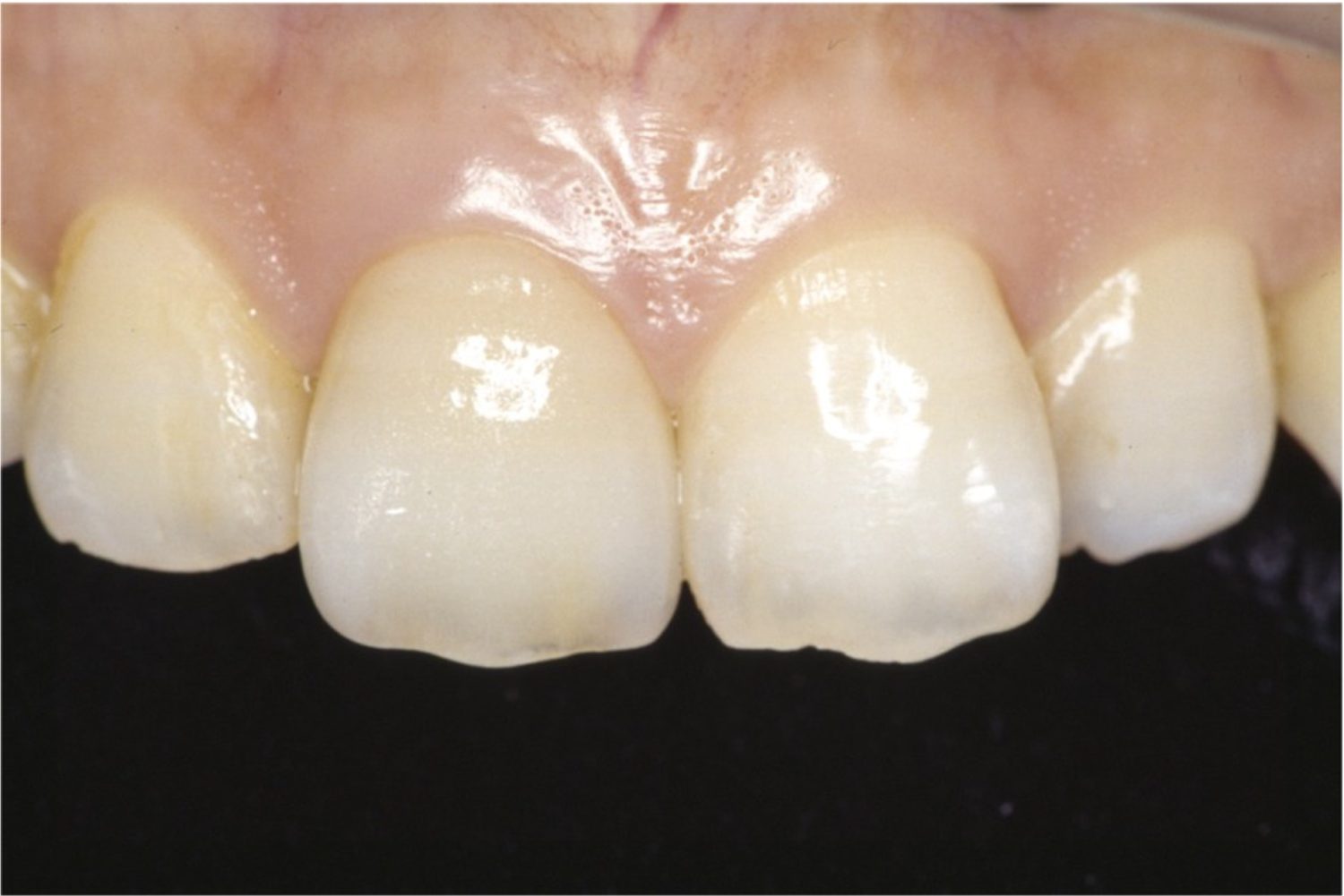 アフター前歯1本の審美修復の症例紹介（コーヘイデンタルオフィス）
