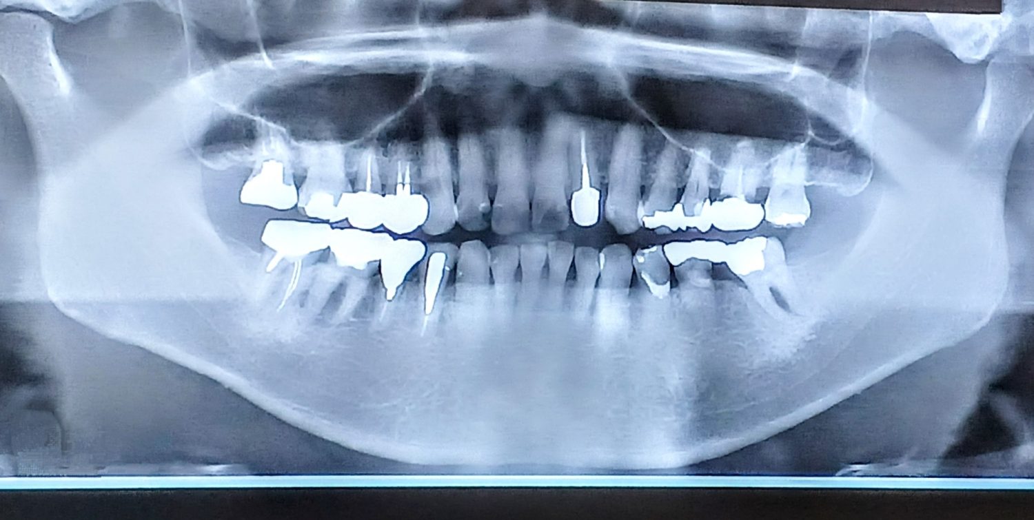 インプラント前にGBRが必要になるケース