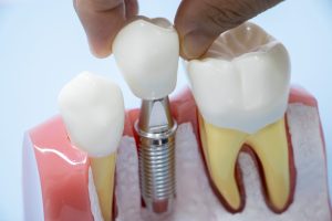 インプラント治療の抜歯即時埋入とは？メリット・デメリットや注意点を解説