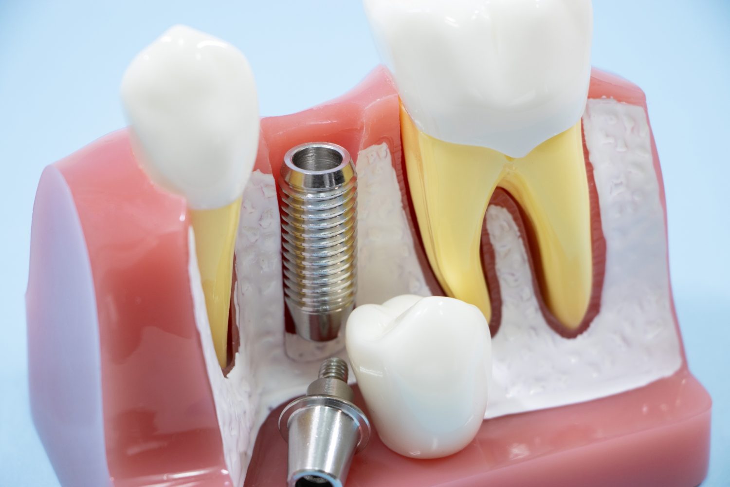 インプラント体の概要
