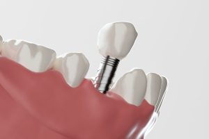 インプラントのサージカルガイド費用はいくら？メリット・デメリットや治療の流れを解説